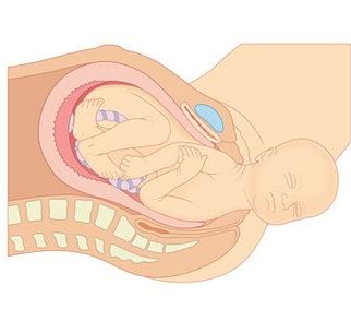 Vaginal Birth After Cesarean