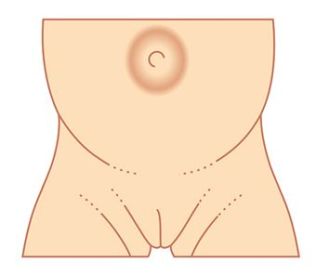 Umbilical Hernia During Pregnancy