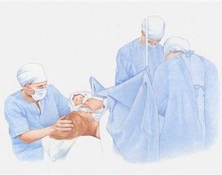 Cesarean Birth 