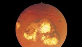 Ocular Toxoplasmosis Treatment in Pregnancy