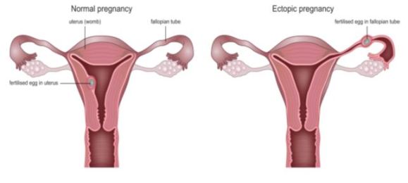 Symptoms of Ectopic Pregnancy at 7 Weeks