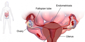 endometrial ablation