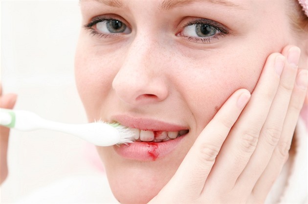 Is Bleeding Gums During Pregnancy a Sign of Periodontitis?